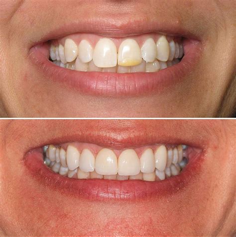 direct resin veneers.